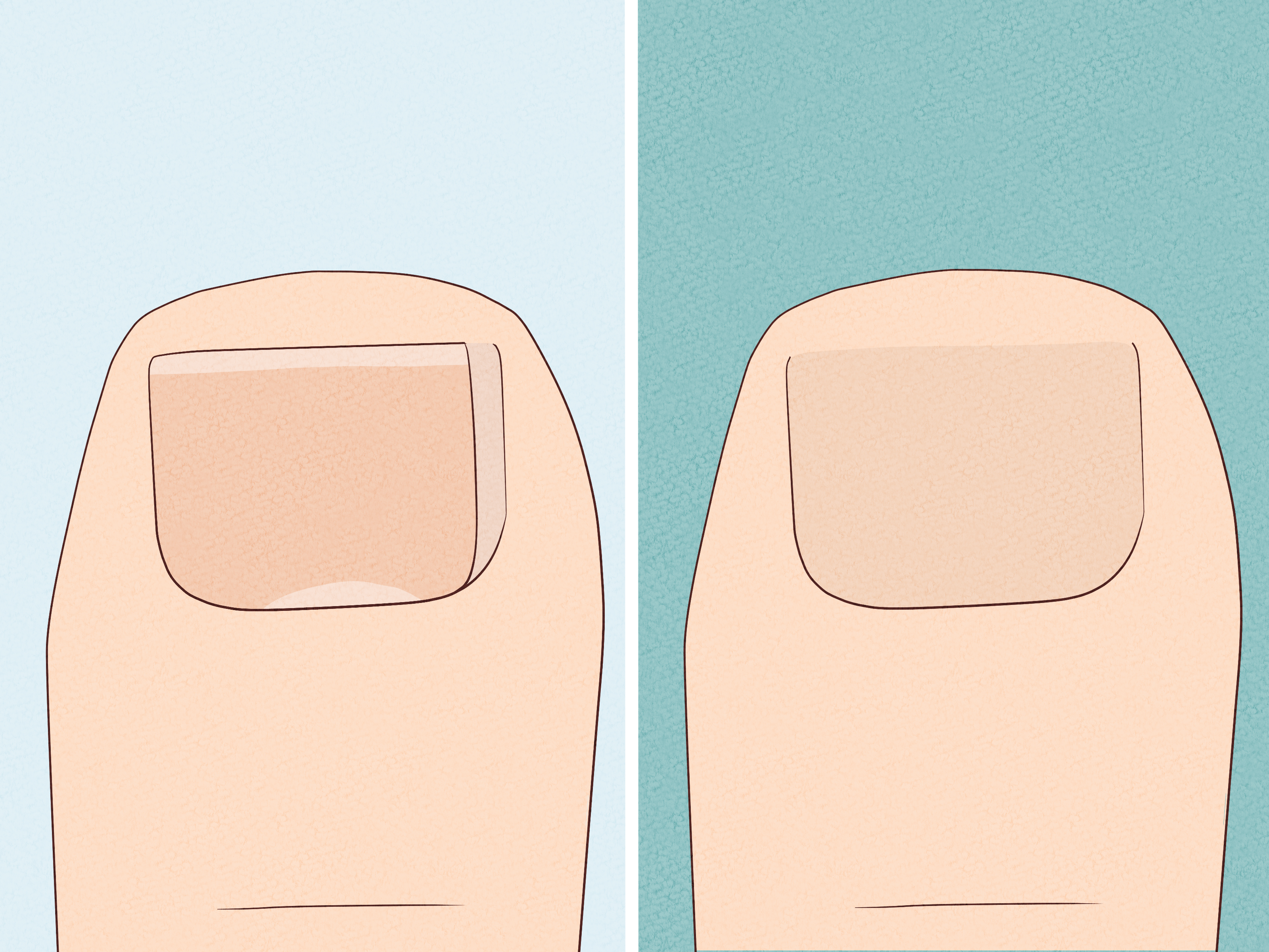 3 Ways to Heal an Ingrown Toenail