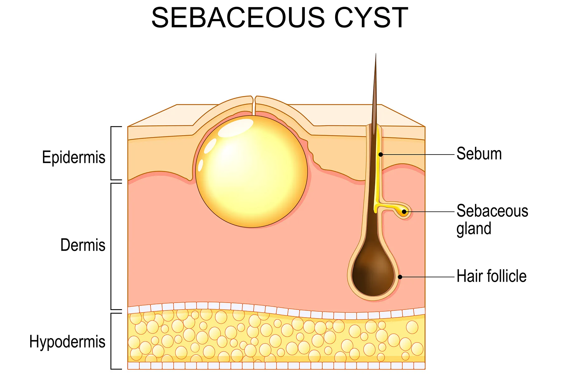 Skin Cyst Treatment: How To Get Rid Of a Skin Cyst